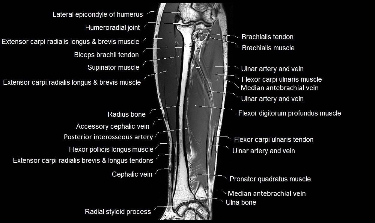 MRI 3T forearm coronal cross sectional anatomy image 15.webp